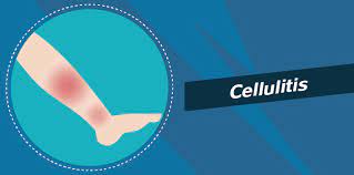 Although it is a common condition but it is not usually very serious. The Worst Infections Caused By Ingrown Hairs Tend Skin Blog