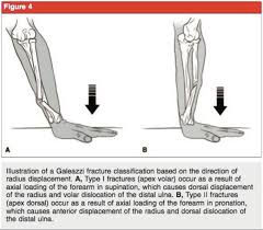 Image result for Galeazzi Sign