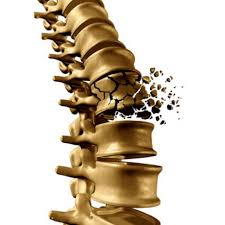 Wirbelbruch Bei Osteoporose Schmerztherapie Und Behandlung Gelenk Klinik De