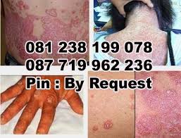 Cara menghilangkan gatal di badan dan alergi kulit tips sehat cara bagaimana pencegahan alami penanganan dengan mudah. Cara De Nature Cara Menghilangkan Gatal Gatal Di Seluruh Tubuh