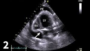 In patients with any pe, the standard chest . Canine Pericardial Effusion Clinician S Brief