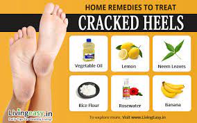 A healthy diet can heal your cracked heels. Cracked Heels Remedies Prevention Tips And Care At Home