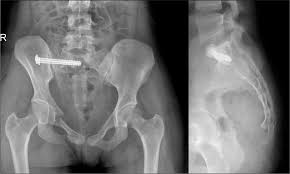 Traumatic Posterior Dislocation Of Sacrococcygeal Joint A Case Report And Review Of The Literature Surgical Neurology International