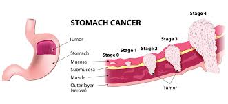 Cancer in cats can occur in any location or body system, and most symptoms can be detected externally. Stomach Cancer Treatment In Anchorage Alaska Surgical Oncology Alaska Breast Cancer Oncologists In Anchorage