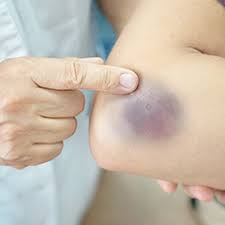 Questi limiti sono determinati dal 2,5 ° percentile inferiore e superiore. Ematoma Superficiale O Pericoloso Quando Chiedere Aiuto Issalute