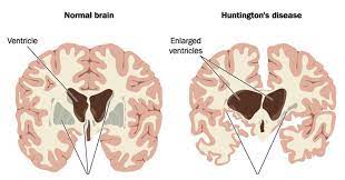 Archive Of Standardized Exam Questions Huntington Disease Hd Stepwards