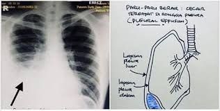 Lung, lungs, lunged, pnumonia, brokitis, pulmonary, pneumonia. Facebook