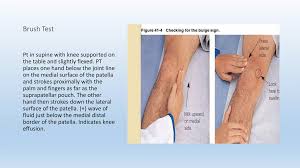 Image result for Knee Bulge Sign