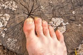 Aufgedeckt Hilft Terbinafin Gegen Nagelpilz Erfahrungen