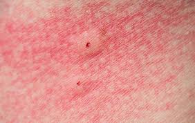 Image result for Spider Bite