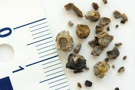 According to the new surveys, caffeinated coffee kidney stones help fight the formation as well as eradication of the stones. Kidney Stones Are On The Rise Harvard Health