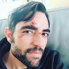 Dani Mateo se rompe la cara por el referéndum en Cataluña