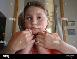 ADVANCE FOR WEEKEND MAY 1-5 ** Katlin Cody,10, is held in the arms of her  mother, who stills the girl's erratic movements with a firm hug, at their  Belle Terre, N.Y.,