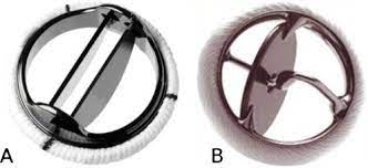 A type of bileaflet valve consisting of a dacron sewing ring and pyrolytic carbon leaflets and housing, with the leaflets opening artificial heart valve — an artificial heart valve is a device implanted in the heart of a patient with heart valvular disease. Photograph Of A St Jude A And Medtronic Hall Aortic Valve B Both Download Scientific Diagram