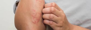 Why am i itching all over my body? Eczema Diet Tips 6 Foods To Eat If You Have Eczema The Dermatology Center Of Indiana