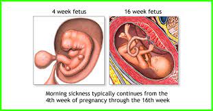 15 Home Remedies For Vomiting During Pregnancy & Prevention