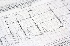 Tachycardia Causes Symptoms And Treatments