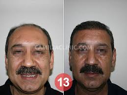 زراعة الشعر في تركيا قبل وبعد بتقنية الاقتطاف نتيجة عملية الزراعة بعد 8 اشهر بمركز كاميليا كلينك تمت زراعة 4500 بصيلة شعر 00905444488340 Www Cam