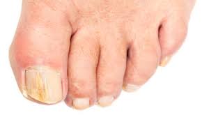 Can curved toenails be corrected? 10 Top Tips For Ageing Toenails Starts At 60