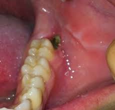 Visiting the dentist to have your wisdom tooth removed may be a relatively smooth experience. Wisdom Teeth Extraction Smile Recreation