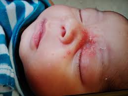 Down's syndrome is clearly the most common and recognizable genetic syndrome known, although at times the physical features may be difficult to identify in a newborn. Newborn S Rash Involves Eyes And Nose