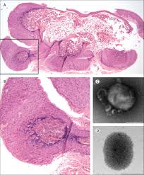 Molluscum contagiosum (mc), also known as water warts, is an infectious skin condition that results in groupings of small bumps or lesions on the upper layers of the skin. References In Molluscum Contagiosum Virus Infection The Lancet Infectious Diseases