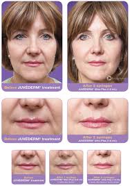 1 syringe of juvederm ultra. Fillers Spa By Md