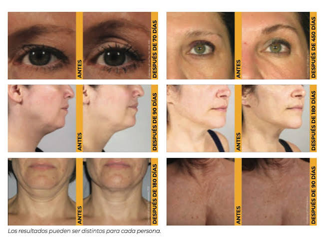 ULTHERAPY PRIME® - Clínica Natalia Gil - Bilbao