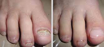 Image result for Onychogryphosis feet