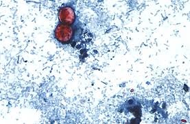 Cyclospora outbreaks with no confirmed sources grow: FDA