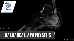 Image result for Calcaneal Apophysitis
