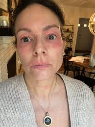 🖐️ The skin is a map: • Heliotrope rash → dermatomyositis • Malar rash →  lupus • Digital ulcers → systemic sclerosis • Vasculitic lesions → systemic  vasculitis Look at the skin. It whispers secrets.