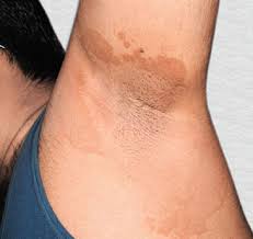 Image result for Erythrasma