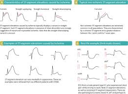Learn All About St Elevations Elevated St Segments On Ecg Diagnosing Acute Myoardial Infarction Stemi And 17 Im Ecg Interpretation Normal Ecg St Elevation