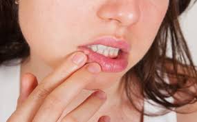 Wenn deine lippe durch eine verletzung geschwollen ist, wird sie während des heilungsprozesses für infektionen anfällig sein. Erkrankungen Der Lippen