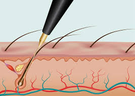 Electrolysis is a way of removing individual hairs from the face or body by inserting a probe into the hair follicle followed by an electrical pulse that is electrolysis can most often be the best alternative for individuals with blonde, red or white hairs which may not be suitable for laser hair removal. Electrolysis Emoveo