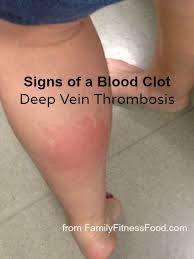 Symptoms and signs of dvt occur in the leg with the blood clot, and include 21 Best Dvt Deep Vein Thrombosis Ideas Deep Vein Thrombosis Thrombosis Dvt