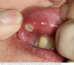 Image result for Canker sores symptoms roof of the mouth