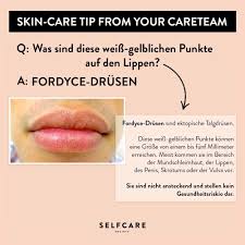 Sie sind weiß und brennen auch wenn ich mir zb die zähne putze oder wenn ich mir den. Weiss Gelbliche Punkte Auf Den Lippen Was Sind Fordyce Drusen Selfcare Society
