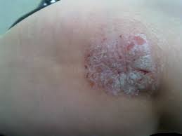 The scales are arranged in an overlapping manner like tiles on a roof or flakes of asbestos, hence the name. Prof Alex Navarini Ar Twitter There Are Different Types Of Scales Pityriasis Sicca Is The White Dry Scaling Caused By Dryness Pityriasis Oleosa Is The Yellowish Scaling Caused By Grease Pityriasis Amiantacea