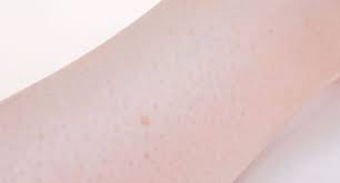 So i guess my simplistic comment is you are your own harshest judge, and what seems like a huge and obvious flaw, other people won't even notice. 3 Ways To Get Rid Of Ingrown Hair Scars Wikihow