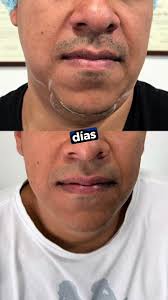 Hoy quiero contarte porque una lipopapada a través de cánula tal vez no sea  la mejor opción para ti 👀❌, sin embargo quiero enseñarte esta esta opción  progresiva 💉 por medio de enzimas que te ayudarán ...