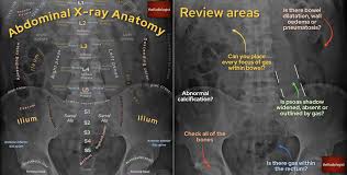 Image result for Abdominal XRay