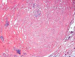 Most benign cystic testicular lesions occur adjacent to this structure histological slide of human testis seen under a microscope at. Pathology Outlines Adenomatoid Tumor