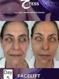 Descubre el secreto de TESS para un rejuvenecimiento facial sin cirugía!