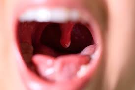 Image result for Uvulitis