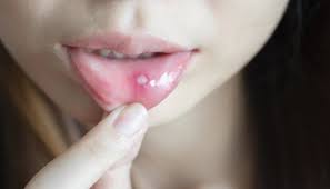 Image result for Canker sores roof of mouth
