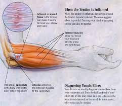 Expert Massage Techniques For Tennis Elbow Tennis Elbow Tennis Elbow Treatment Massage Therapy