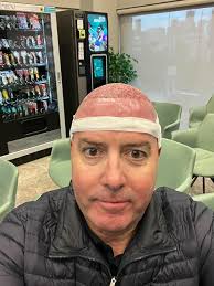 Join me as I share my personal journey of undergoing my second hair  transplant at the renowned Hairtran Clinic in Ekkamai, Bangkok. After  incredible results from my first procedure with Dr. Patty