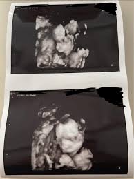 Image result for Micrognathia